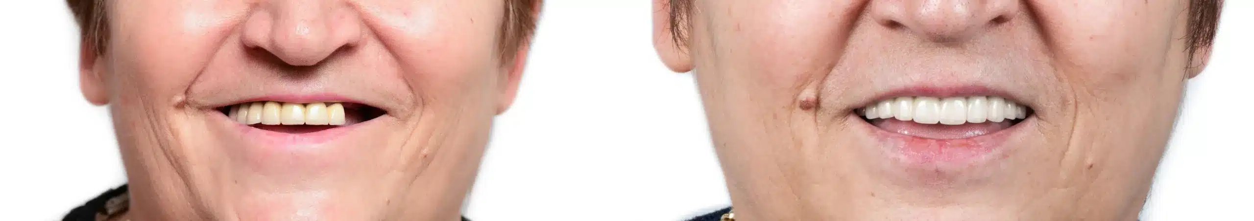 Dental Implants: A Long-Lasting Solution for Missing Teeth