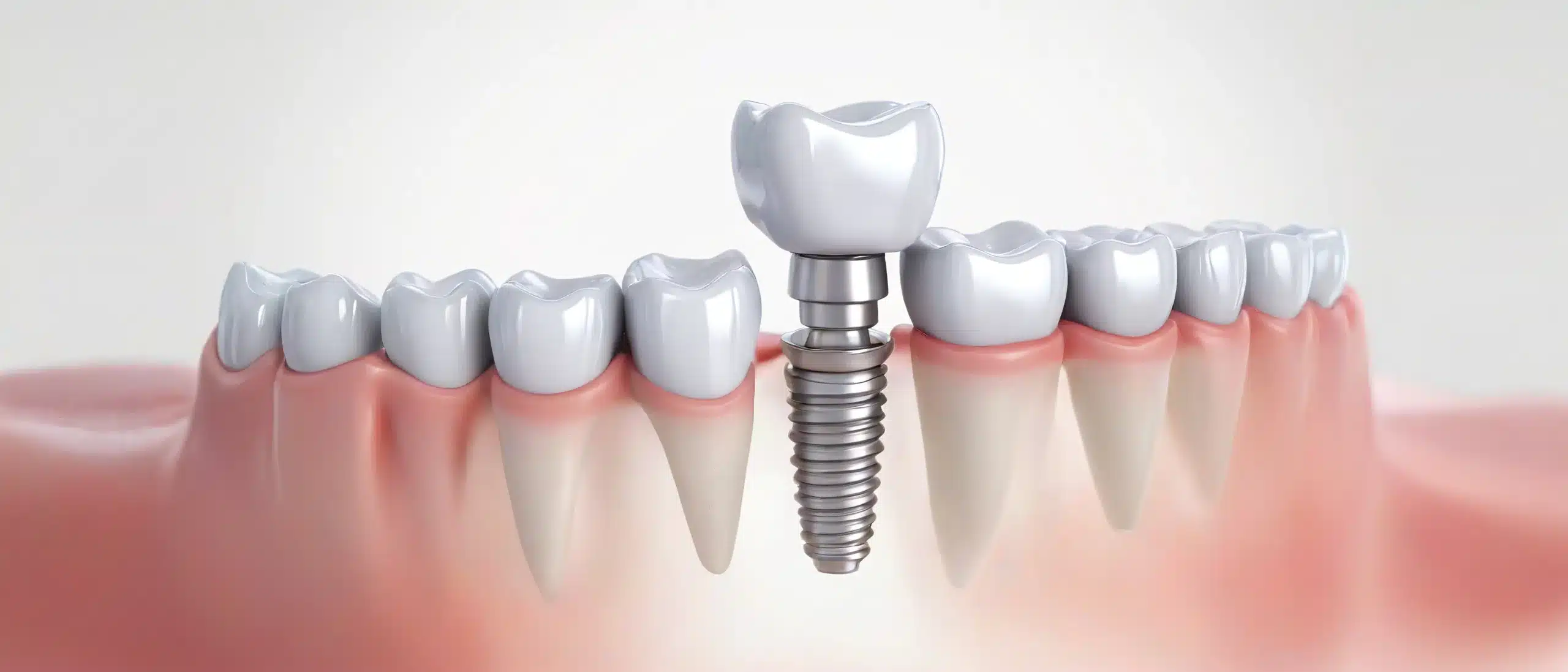 Dental Implants: A Long-Lasting Solution for Missing Teeth