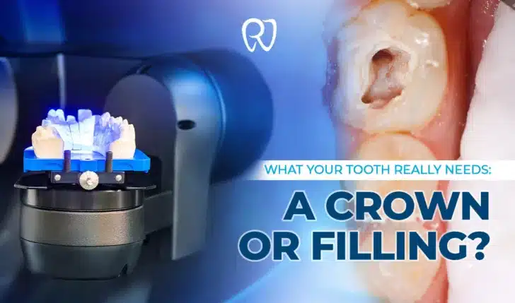 Crowns or Fillings? Know the Difference